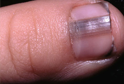 dấu hiệu bệnh qua móng tay - hình minh họa 8