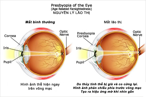 lão thị ở người già
