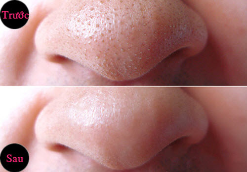 sạch mụn đầu đen